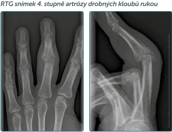 Artrita și artroza Korodetsky