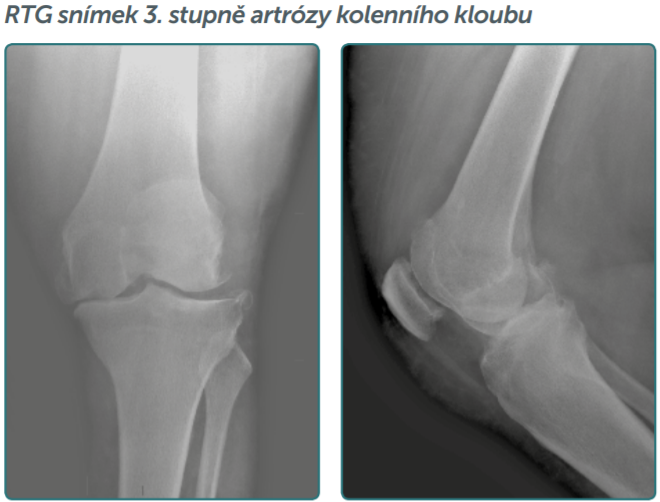 artróza 3 stupně kolene