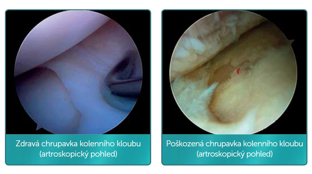 zdravá chrupavka a poškozená chrupavka kolenního kloubu